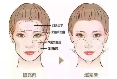 玻尿酸豐太陽(yáng)穴能保持多久？術(shù)后的注意事項(xiàng)有哪些？