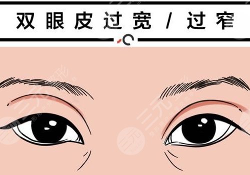 雙眼皮修復大概多少錢呢？
