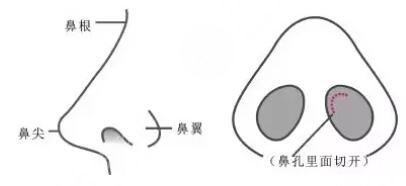 假體隆鼻后假體外露怎么辦?