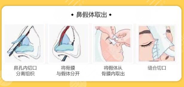 假體隆鼻后護理事項