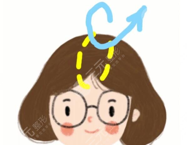 顱頂增高