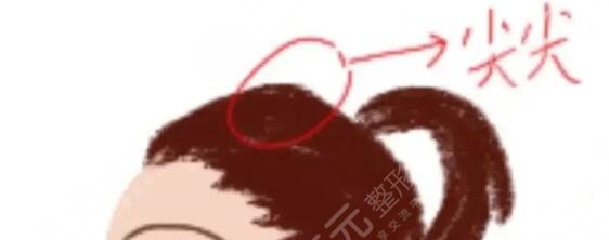 顱頂增高
