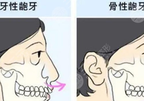 嘴凸怎么辦？