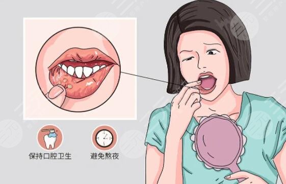 　　快速治口腔潰瘍偏方都有哪些?口腔潰瘍的發(fā)生，給我們的口腔內(nèi)部帶來了很大的困擾。對于經(jīng)常性和突發(fā)性的口腔潰瘍患者來說，掌握一些快速緩解口腔潰瘍的小辦法，就會得到比較好的緩解效果。為了滿足我們廣大朋友的現(xiàn)實(shí)需求，小編就整理了幾個緩解口腔潰瘍的小辦法。在這篇文章中，有著比較詳細(xì)的介紹。有需求的朋友可以參考一下。  　　1、快速治口腔潰瘍偏方有哪些?  　　口腔潰瘍的出現(xiàn)也是有多種情況引起的?？谇粷兊某霈F(xiàn)，也會引起我們身體各方面的不適癥狀。而出現(xiàn)這種癥狀，我們就采用一些緩解偏方來緩解。常用的方法就有姜水漱口、維生素B2、濃茶漱口、蘿卜藕汁、維生素C片等等多個方面。  　　(1)、姜水漱口：姜水漱口，也是比較常用的一種方法。在采用姜水漱口的過程中，首先將姜片放在水中進(jìn)行加熱，在這個過程中，就能夠?qū)⒔锩娴奈镔|(zhì)熬在水中。熬好的姜片，每日漱口3次左右，漱口8次左右，就會有了明顯的好轉(zhuǎn)。  　　(2)、濃茶漱口。濃茶漱口作為比較易操作的一種方式，在口腔潰瘍緩解偏方中，也是深受廣大朋友所喜歡的。只需要加高茶葉的濃度，然后漱口即可。這種方法雖然簡單易操作，但是在緩解和緩解周期上，相比較長，需要堅(jiān)持一段時間后，就會得到好的效果。  　　(3)、維生素C片。維生素C片，是比較見效比較快的緩解口腔潰瘍的好方法。在緩解的過程中，只需將維生素C片壓成粉末，然后涂在患處，這樣有幾次后，就會得到明顯的好轉(zhuǎn)和。  　　(4)、蘿卜藕汁:蘿卜藕汁，也是比較常用緩解口腔潰瘍的好方法。就是取生蘿卜2只，鮮藕一段洗凈搗爛絞汁去渣，用汁含漱，每日3次，連用4天可見效。  　　2、口腔潰瘍需要注意事項(xiàng)有哪些?  　　口腔潰瘍發(fā)生后，首先需要注意的是，飲食問題。在飲食中，要注意以清淡為主，不要吃刺激性的食物。過熱，過涼的食物，也不要吃。另外，就是在這個階段中，還需要注意的是養(yǎng)成良好的生活習(xí)慣。不抽煙，不喝酒，不經(jīng)常坐在電腦桌前，還可以做一些適量的運(yùn)動。這些都是有助于口腔潰瘍的緩解辦法的。  　　在這篇文章中，為大家詳細(xì)的介紹了有關(guān)口腔潰瘍的緩解辦法以及小妙招。對于一些簡單的操作方法，我們廣大有需求的朋友可以嘗試一下。相比較嚴(yán)重的朋友，還是建議去醫(yī)院進(jìn)行檢查，接受正規(guī)的緩解。另外就是，在緩解口腔潰瘍的同時，我們應(yīng)該注意的問題。這些直接或者間接的影響到口腔潰瘍的緩解時效。有需求的朋友可以參考一下。