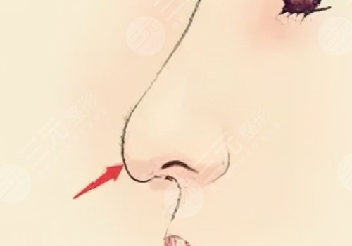 媽生鼻和直鼻微翹的區(qū)別是什么？