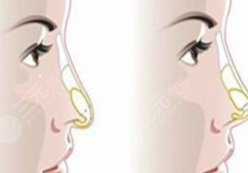 媽生鼻和直鼻微翹的區(qū)別是什么？