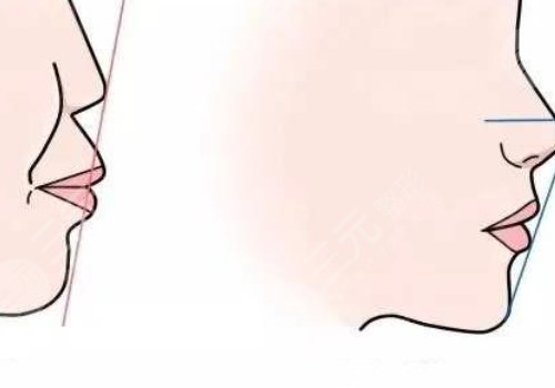 嘴凸是怎么造成的？