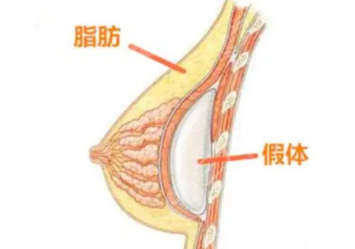 曼托假體豐胸4個月還摸的到假體正常嗎