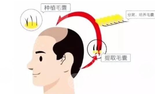 毛發(fā)種植手術(shù)費(fèi)用是多少?