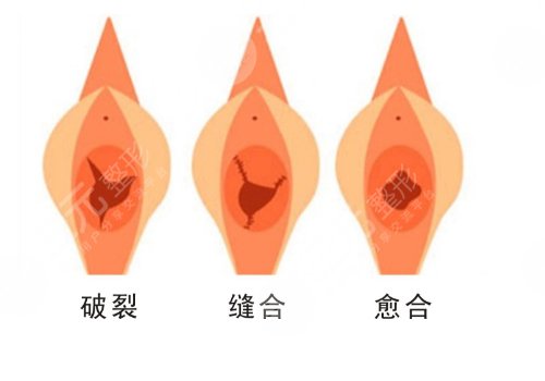 補(bǔ)處膜修復(fù)后會出血嗎？