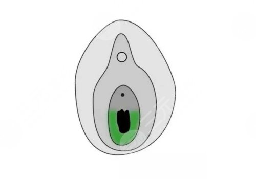 補(bǔ)處膜修復(fù)后會出血嗎？