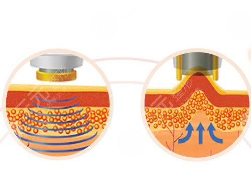 像素射頻儀器祛疤有用嗎？