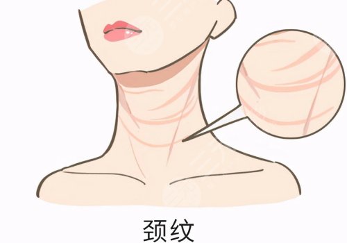 頸紋特別深怎么去除？