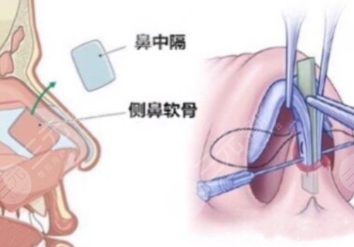 軟骨隆鼻大概多少錢