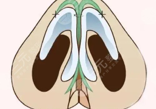 肋骨隆鼻肋骨取了對身體有影響嗎？