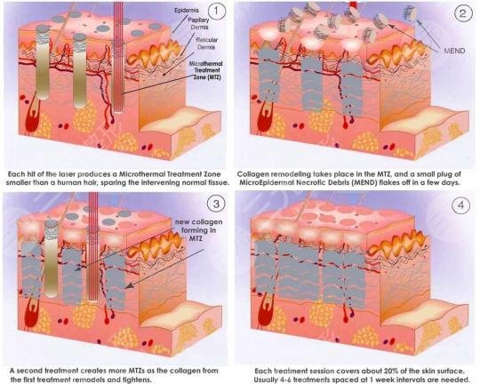 像素射頻儀器祛疤有用嗎？