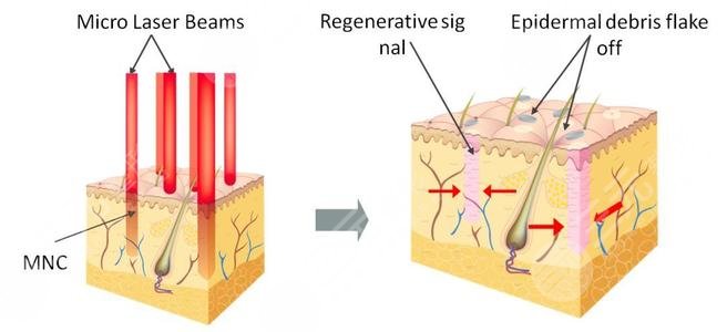 像素射頻儀器祛疤有用嗎？