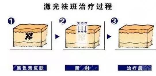 哪種激光祛斑效果好留疤小?