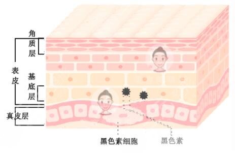 激光祛斑會(huì)不會(huì)反彈?