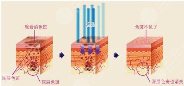 激光去斑后能保持幾年?