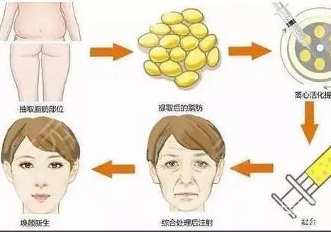 玻尿酸豐面頰好還是自體脂肪好？
