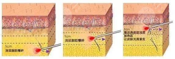 瘦小腿的方法有哪些？