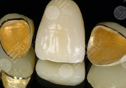 鈦合金烤瓷牙多少錢一顆？