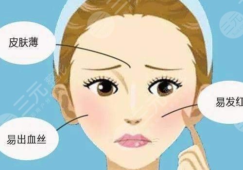 臉上長紅血絲怎么去掉？