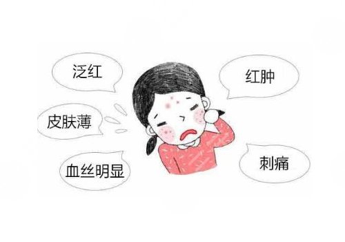 臉上長紅血絲怎么去掉？