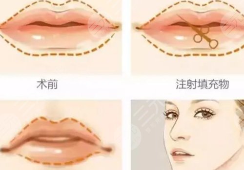 玻尿酸豐唇能維持多久？
