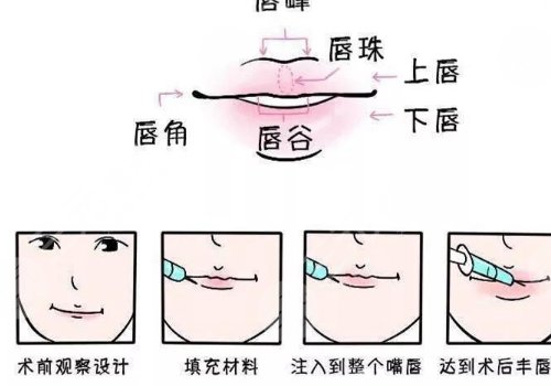 玻尿酸豐唇能維持多久？