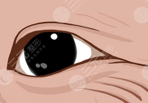 魚尾紋怎么才能去掉？