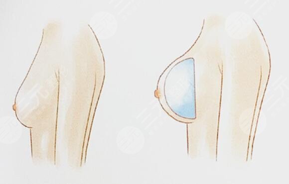 浪漫情懷假體隆胸之后影響哺乳嗎？