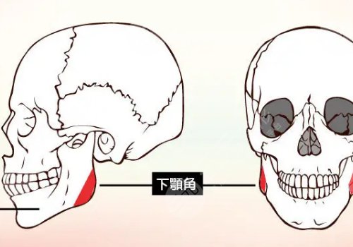 下頜角寬大怎么改良？