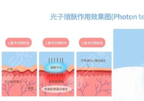 彩光嫩膚和光子嫩膚有什么區(qū)別？