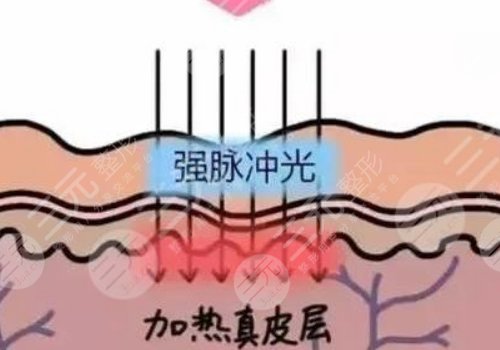 彩光嫩膚和光子嫩膚有什么區(qū)別？