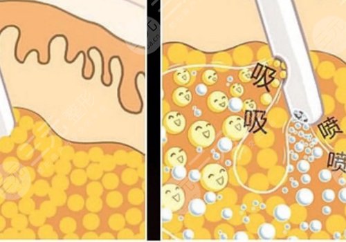 腹部抽脂術(shù)后需要修復(fù)多久？
