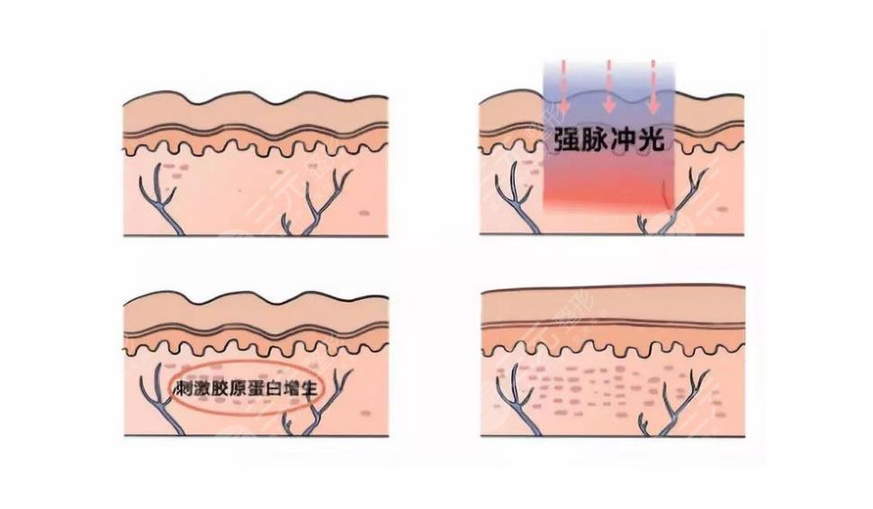 臉上皮膚粗糙毛孔粗大怎么才能恢復(fù)得好？