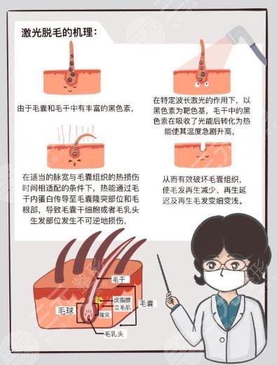 男士激光脫毛效果如何？