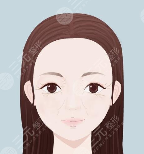 怎樣防止魚尾紋及保養(yǎng)方法，分為醫(yī)美和非醫(yī)美兩種方案！