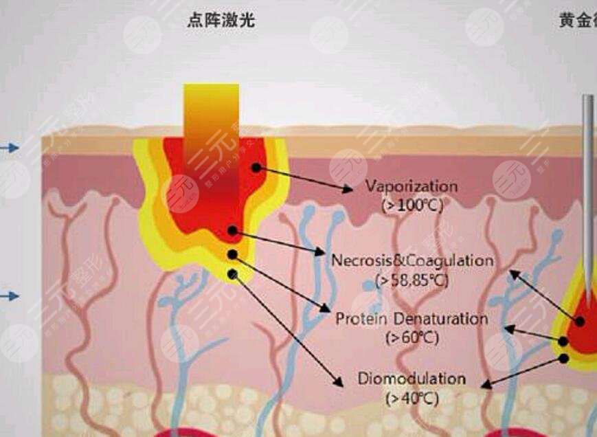復(fù)合彩光嫩膚的效果怎么樣?