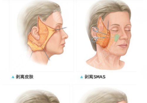 上海伊萊美拉皮多少錢(qián)?
