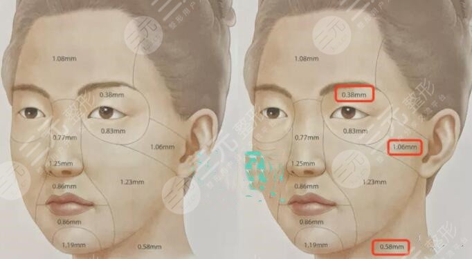 面部下垂做哪種醫(yī)美手術(shù)好?