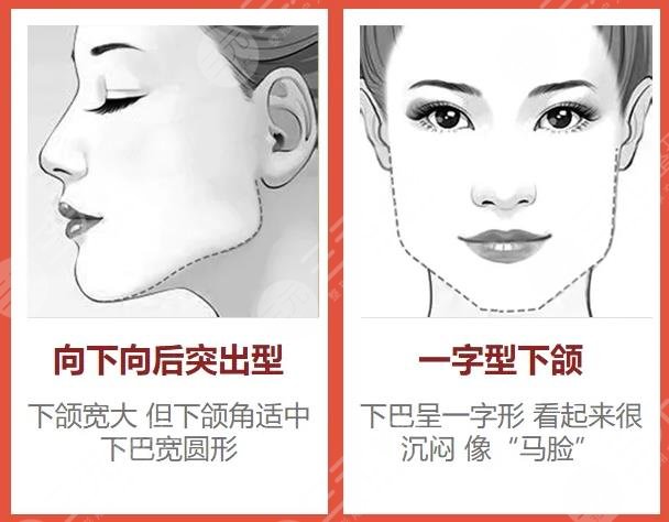 削骨手術(shù)一般要多少錢？