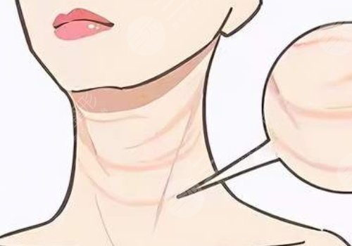 頸紋填充能維持多久呢？色素沉著能消退嗎？