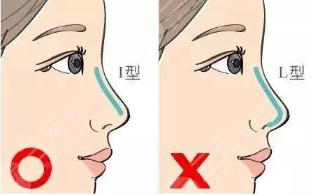 膨體隆鼻的缺點有哪些？多少錢|怎么護理？