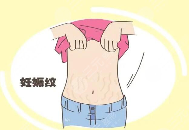 橄欖油去除妊娠紋需要配合使用身體乳嘛？使用方法