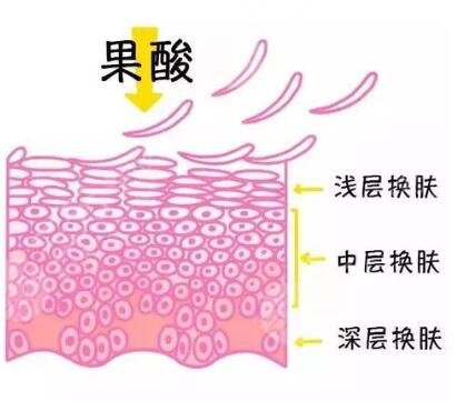 果酸換膚的副作用多久會顯現(xiàn)出來?