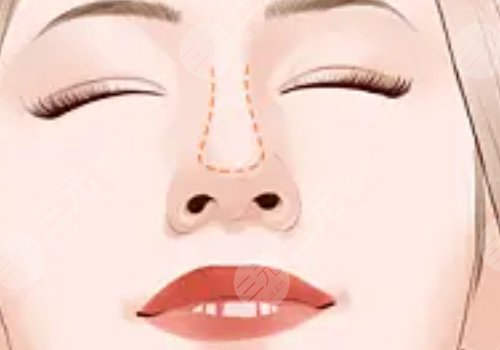 杜**做的鼻子好看嗎?