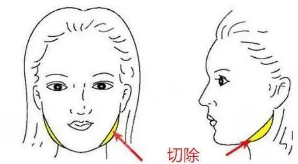 消除下頜角手術(shù)風(fēng)險(xiǎn)大嗎